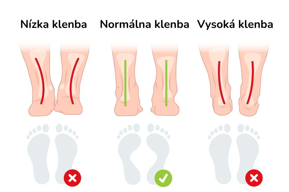 SK  Typy chodidel - výška klenby